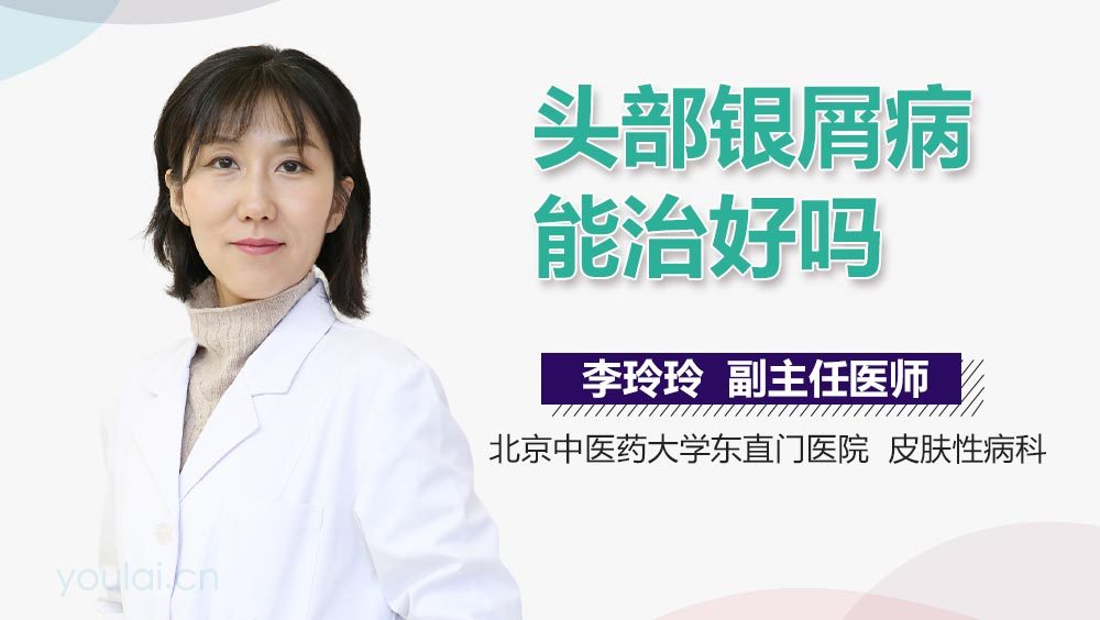 头部银屑病能治好吗