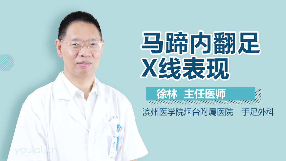马蹄内翻足X线表现