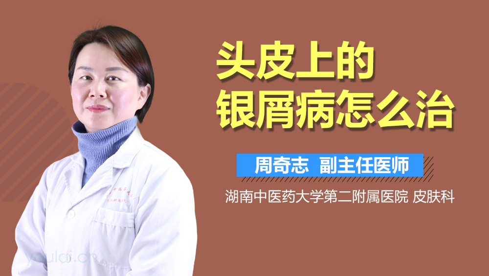 头皮上的银屑病怎么治