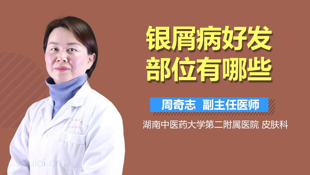 银屑病好发部位有哪些
