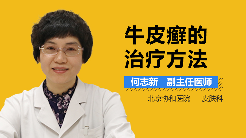 牛皮癣的治疗方法